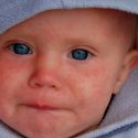 La OMS alerta de que los brotes de sarampión "continúan propagándose rápidamente" en todo el mundo