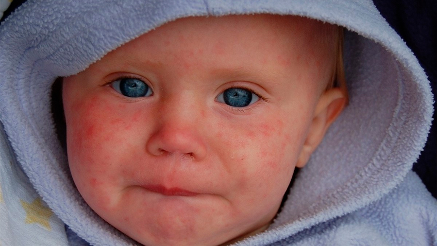 La OMS alerta de que los brotes de sarampión "continúan propagándose rápidamente" en todo el mundo