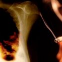 Enfisema pulmonar: la contaminación perjudica como un paquete de tabaco al día