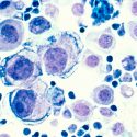 Describen una alteración en cáncer de cáncer que cambia la actividad de un centenar de genes