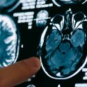 Descubren que una proteína del cerebro retrasa la progresión del alzhéimer