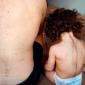 España: etiquetan mal medicina y niños contraen “síndrome del hombre lobo”