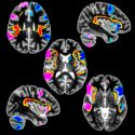 Los zurdos tendrían estructuras cerebrales y genéticas distintas a las de los diestros
