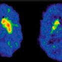 Los opiáceos dañan el sistema de recompensa del cerebro y provocan así la recaída en el consumo