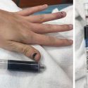 Extraño caso de una mujer a la que la sangre se le volvió azul