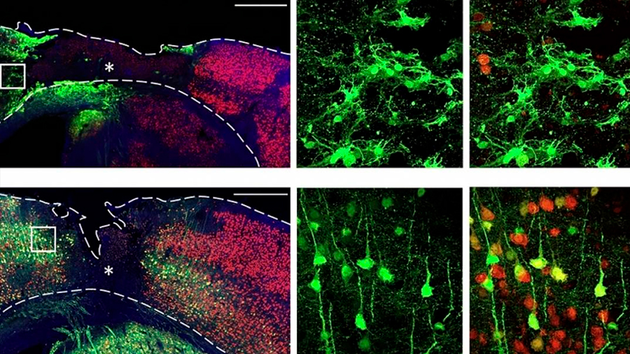 Logran con terapia génica regenerar neuronas pérdidas en accidentes cerebro vasculares