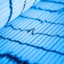 La IA puede anticipar la muerte de pacientes cardiacos