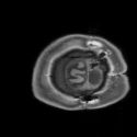 Lo que hemos aprendido gracias a seis personas que solo tienen medio cerebro