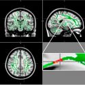 Encuentran daños cerebrales en adolescentes obesos que les hacen seguir comiendo