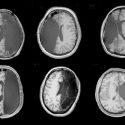 Neuroplasticidad: el cerebro puede re-organizarse incluso luego de perder todo un hemisferio