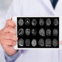 Demuestran cómo ciertas proteínas pueden regular el desarrollo del Alzheimer o Parkinson