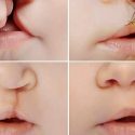 El cordón umbilical podría utilizarse en el tratamiento de labio leporino