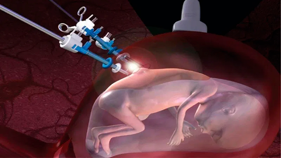 Un hito médico, operan por primera vez la columna de un feto sin sacarlo del útero de su madre