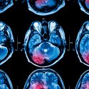 Los tumores cerebrales remodelan las sinapsis neuronales para promover su crecimiento