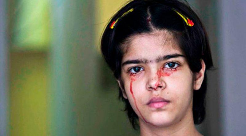 El extraño caso de una niña que sangra por los ojos entra a formar parte de la literatura médica