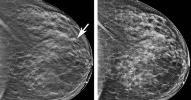 Las células de cáncer de mama convierten a las células inmunes asesinas del cuerpo en aliadas