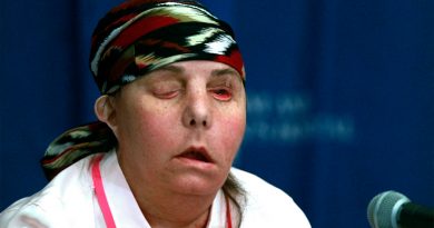 Realizan segundo trasplante de cara a una mujer en EU