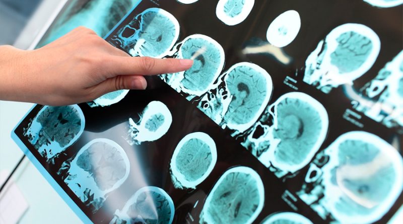 Científicos identifican un tipo de alzhéimer que afecta a personas más jóvenes