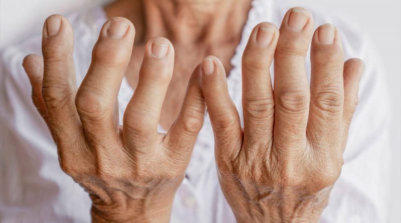 Una molécula creada en laboratorio muestra resultados positivos en el tratamiento de la artritis