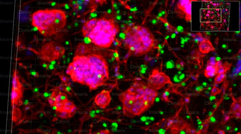 Investigadores revelan cómo las células cancerosas reclaman su 'espacio' en los tumores