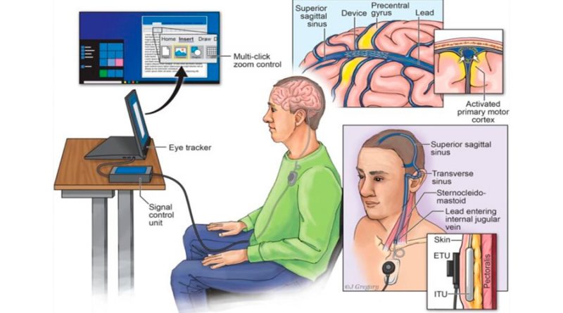Crean chip cerebral que permite a pacientes de ELA enviar correos electrónicos y accionar vía Internet