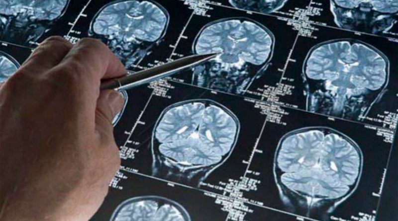 Hallan cambios cerebrales 20 años antes del diagnóstico de alzhéimer