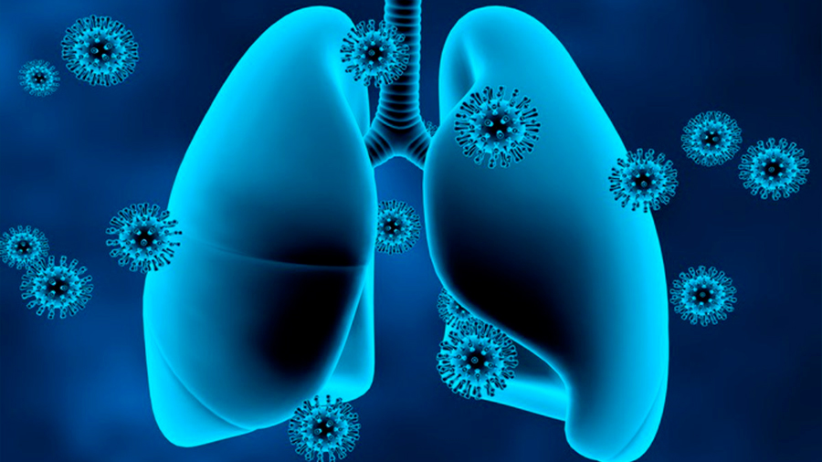 La mayoría de los pulmones se recuperan bien tres meses después del COVID-19