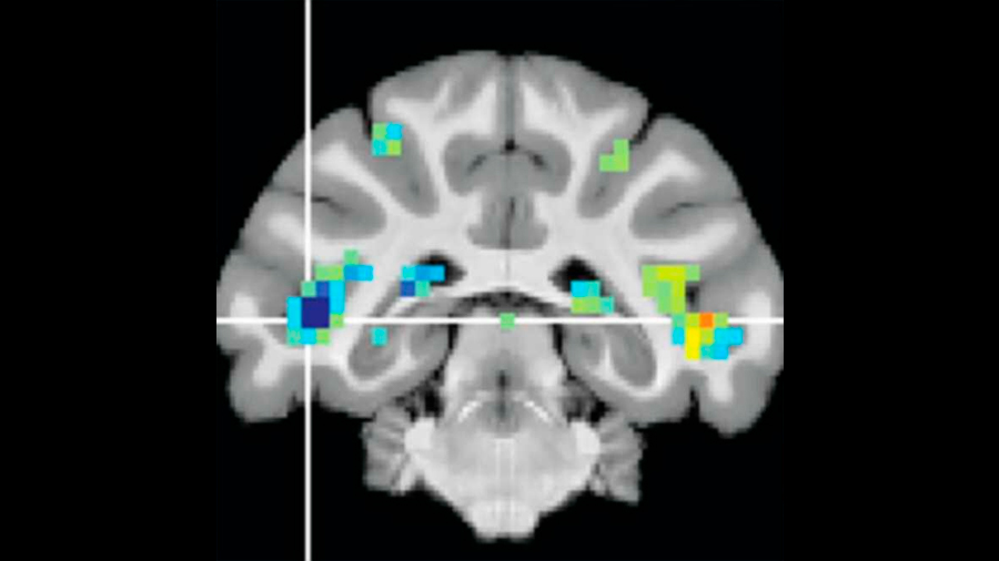 Descubren una región cerebral crucial para reconocer sucesos visualmente