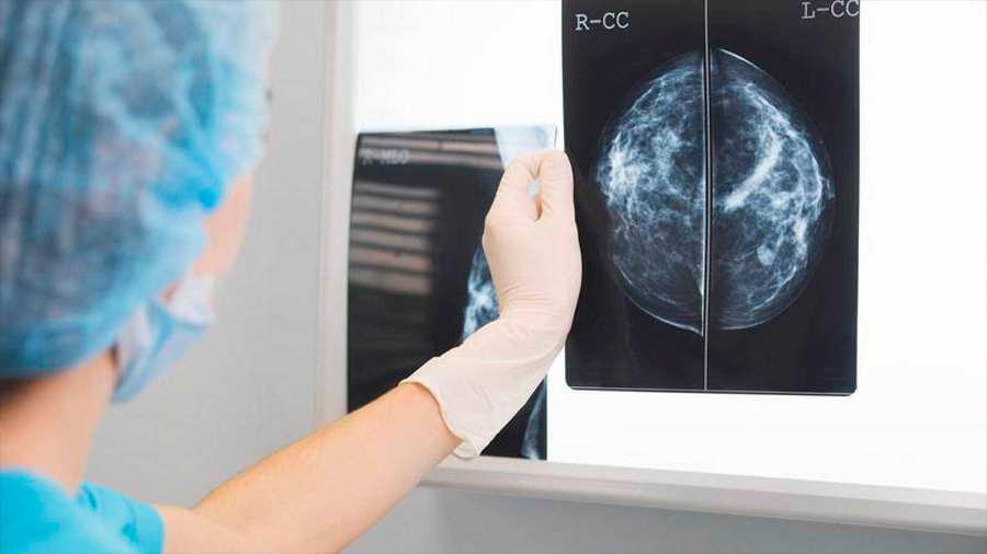El cáncer de mama es ya el tumor más frecuente en el mundo
