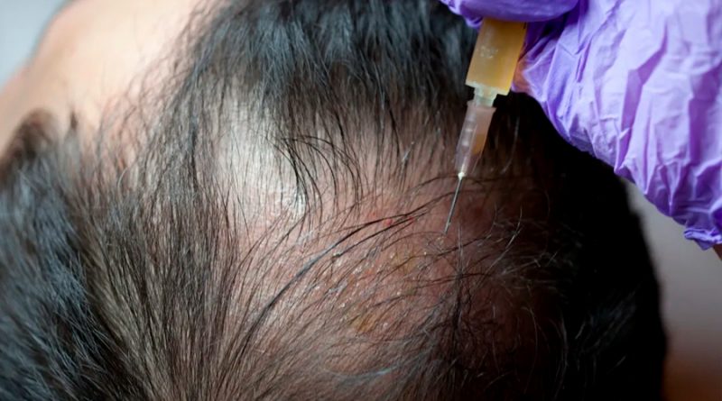 Investigadores japoneses descubren células madre para la regeneración de cabello