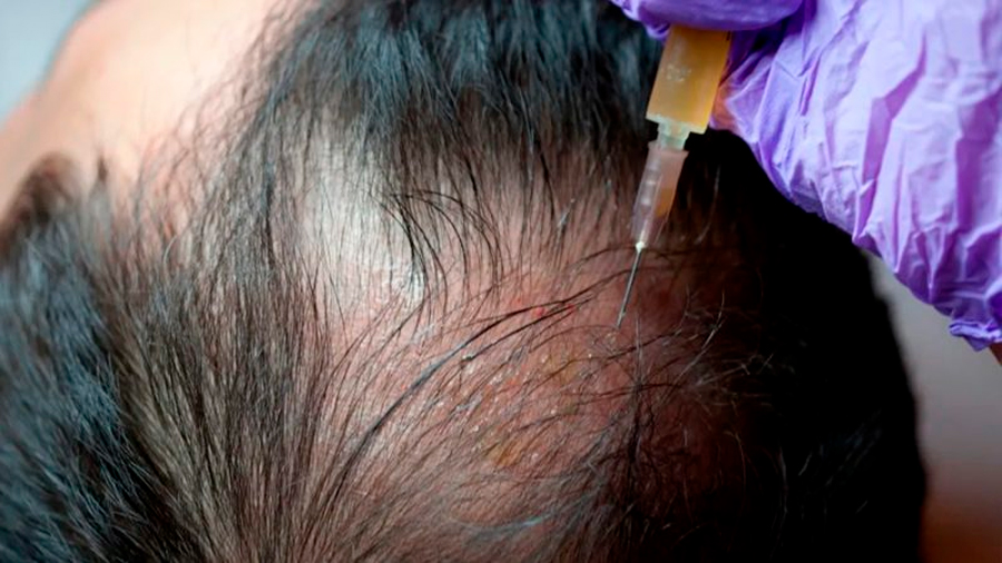 Investigadores japoneses descubren células madre para la regeneración de cabello
