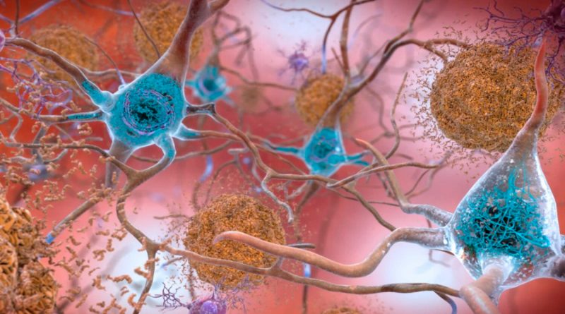 Identifican un fármaco que reduce o elimina las placas amiloides de la enfermedad de Alzheimer