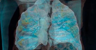 Realizan en Japón el primer trasplante de pulmón a partir de donantes vivos
