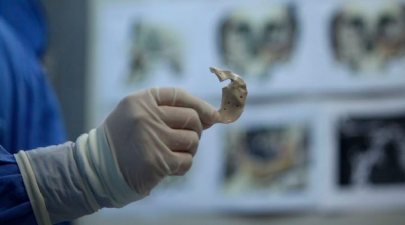 Con tecnología tridimensional, médicos del hospital "La Raza" logran reconstrucción maxilofacial