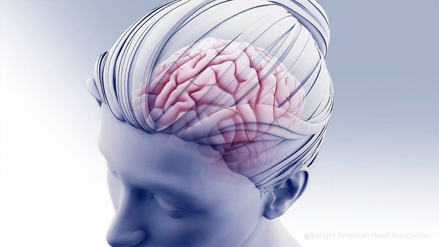 Un dispositivo cerebral implantable alivia el dolor, en un estudio inicial