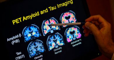 Descubren inesperadamente cobre y hierro en el cerebro de pacientes de Alzheimer