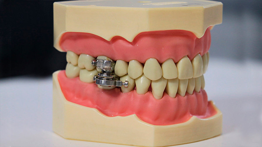 “Candado de dientes”: crean un dispositivo para perder peso que impide abrir la boca