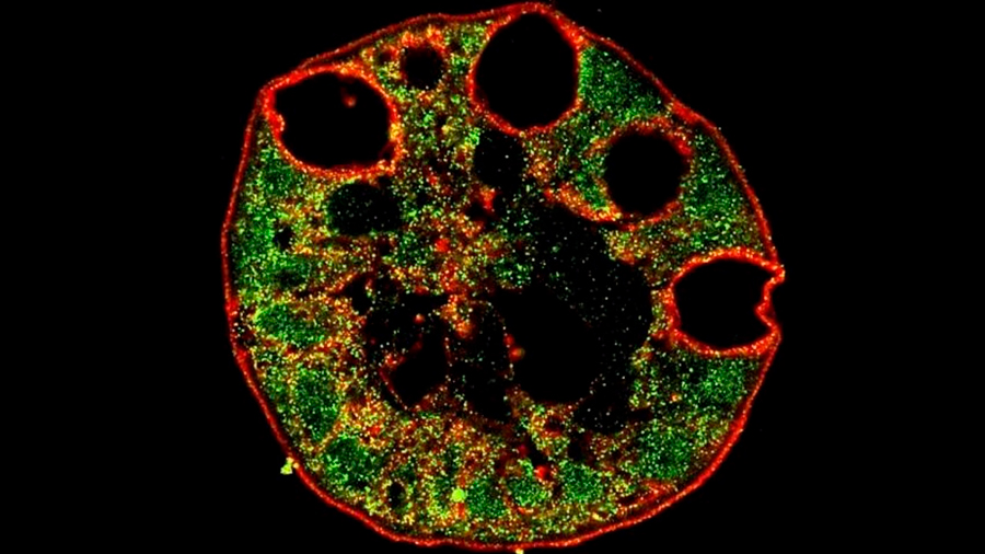 Células anómalas que se vuelven cáncer de esófago surgen en el estómago