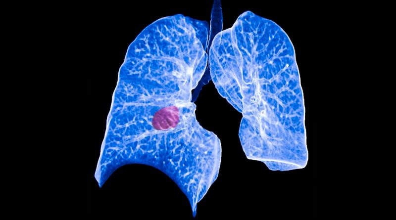 Nueva tecnología de análisis de sangre con IA identifica cánceres de pulmón con gran precisión