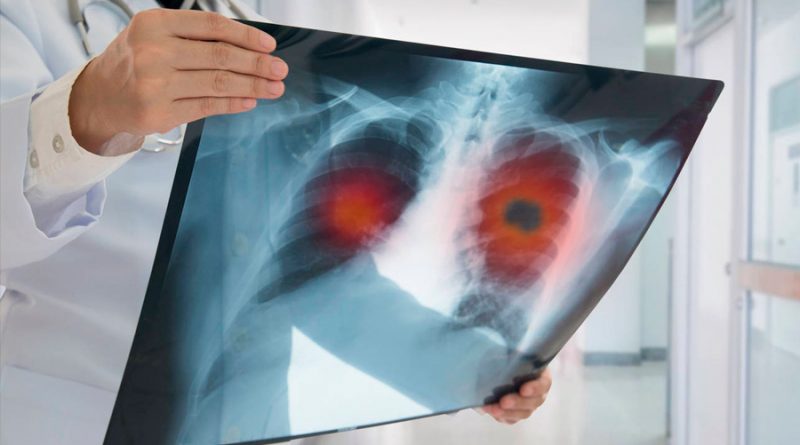 La ciencia descubre cómo diagnosticar el cáncer de pulmón un año antes
