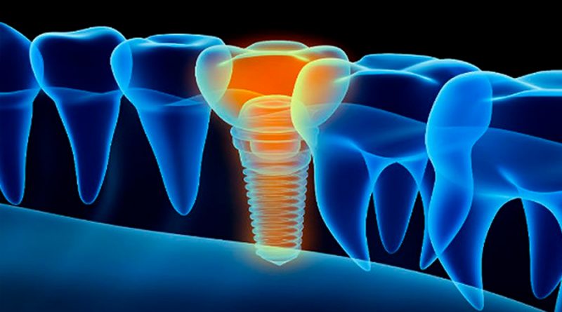 Diseñan implantes dentales inteligentes que combaten las bacterias