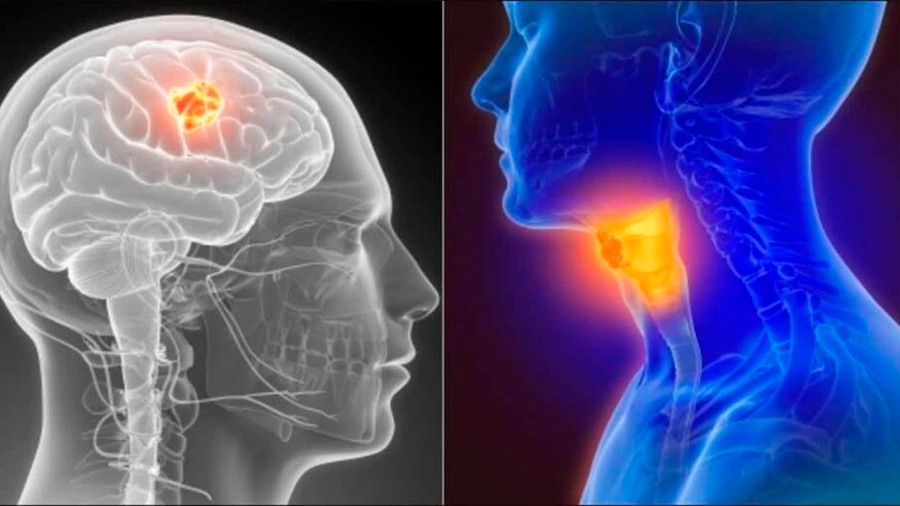 Nuevo tratamiento destruye tumores del cáncer de cabeza y cuello, según estudio