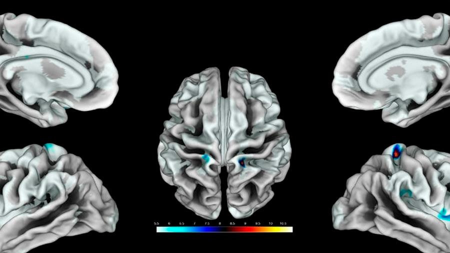 Científicos identifican área del cerebro que corresponde al clítoris