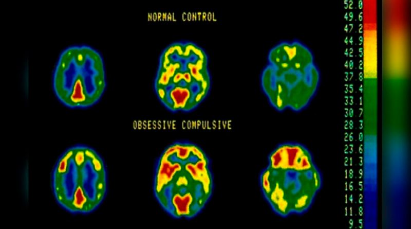 Detectan en tiempo real señales cerebrales asociadas al TOC