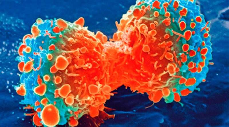 Hallan el gen clave en el desarrollo de cáncer linfático que abre nuevos posibles tratamientos