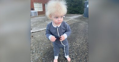 Niño de EU padece el Síndrome del cabello imposible de peinar; ve qué es