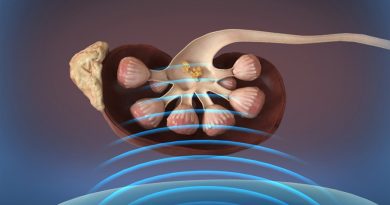 Ondas sonoras eliminan cálculos renales en pacientes despiertos