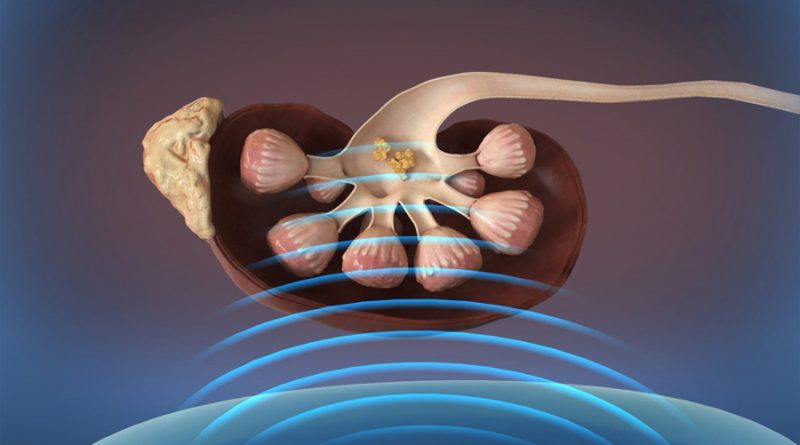 Ondas sonoras eliminan cálculos renales en pacientes despiertos