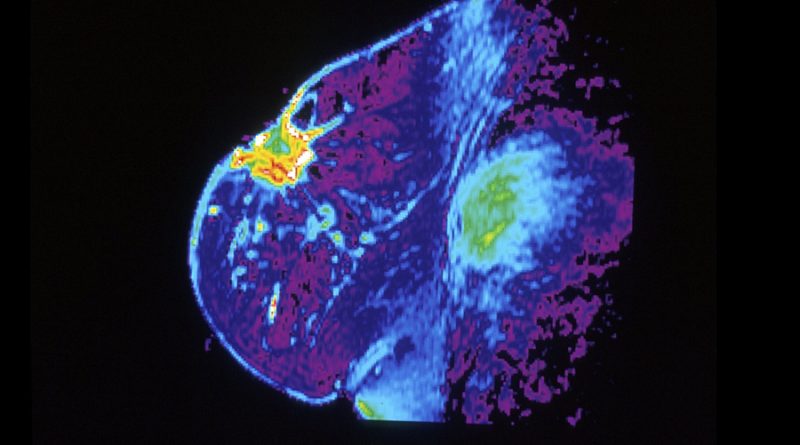 Descubren una proteína que podría eliminar la metástasis del cáncer de mama
