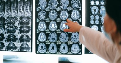 Nuevo método permite hacer mapa cerebral de los síntomas de Alzheimer